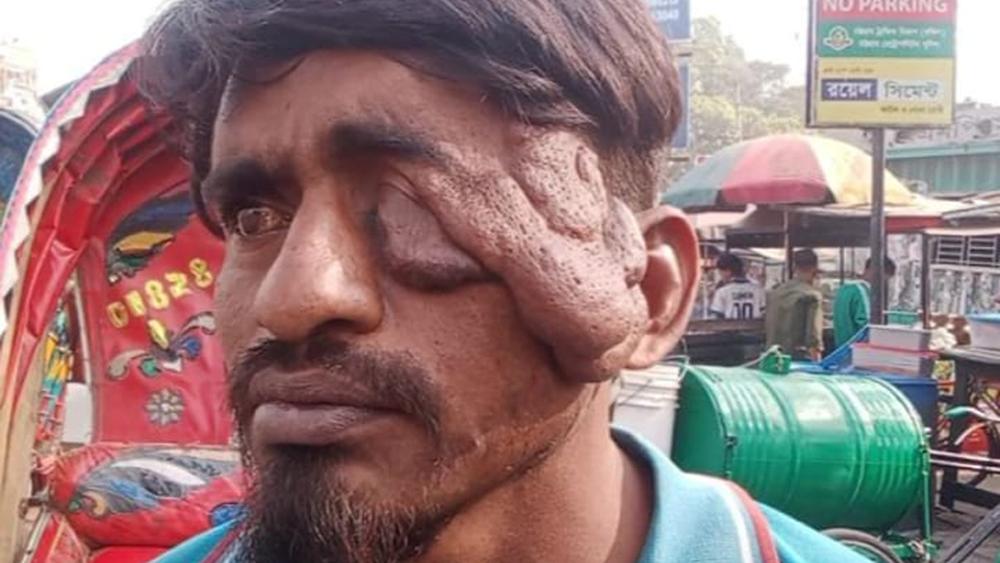 চোখের বাম পাশে বিরল টিউমার, মানবেতর জীবন কাটাচ্ছেন রিকশাচালক মোতালেব - Chief TV